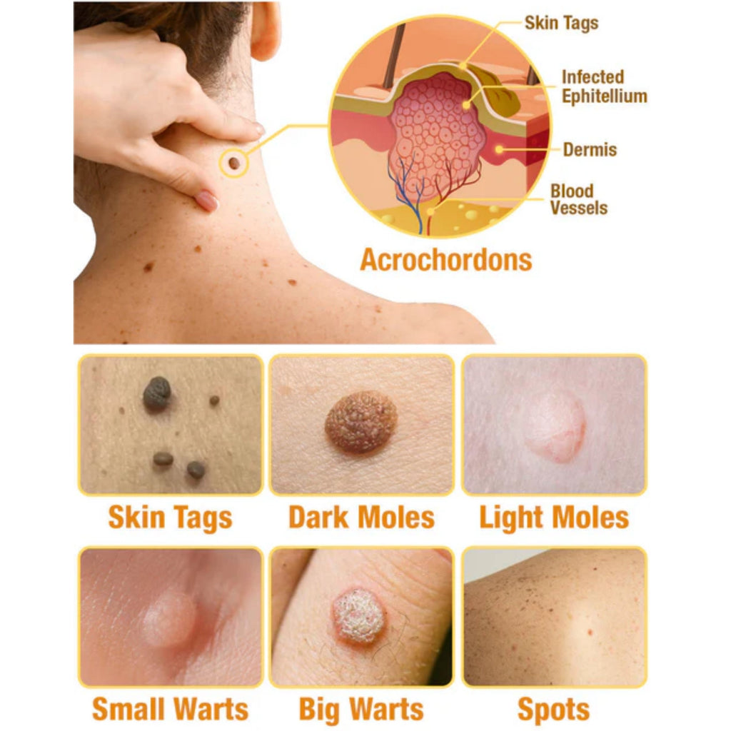 TagAway | Effective removal of warts and skin growths